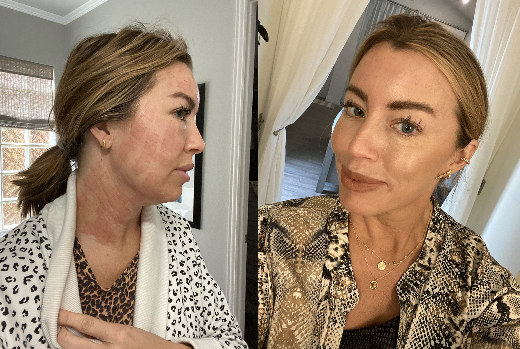 fractora treatment on face and neck before and after pictures