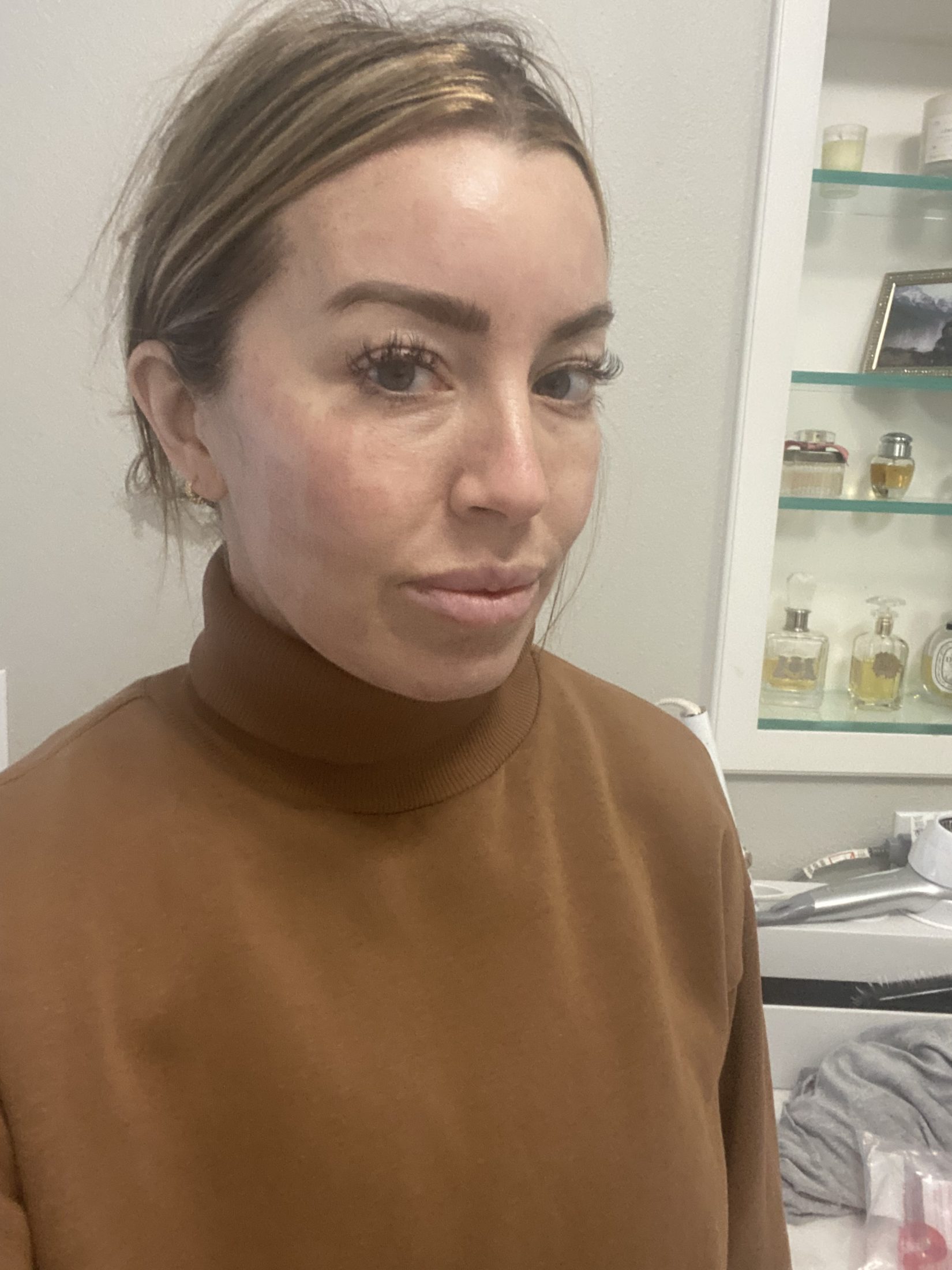 one week after fractora face treatment before and after pictures